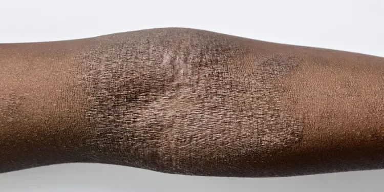 PT Health Watch: Beyond a rash, what eczema really is